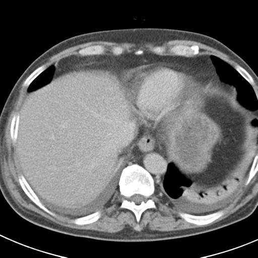 Acute pancreatitis and walled-off necrosis (Radiopaedia 29888-30403 Axial C+ delayed 13).jpg