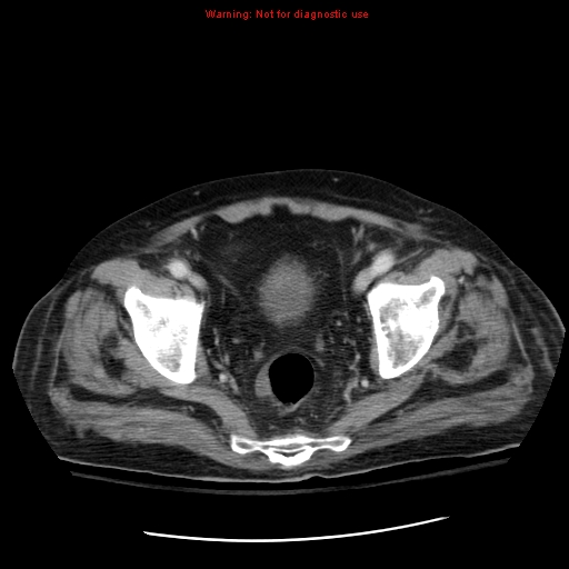File:Acute pancreatitis with incidental pancreatic lipoma (Radiopaedia 10190-10730 Axial C+ portal venous phase 69).jpg