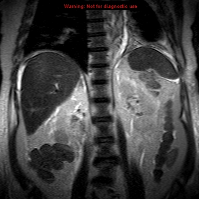 File:Acute pancreatitis with incidental pancreatic lipoma (Radiopaedia 10190-10732 Coronal T2 21).jpg