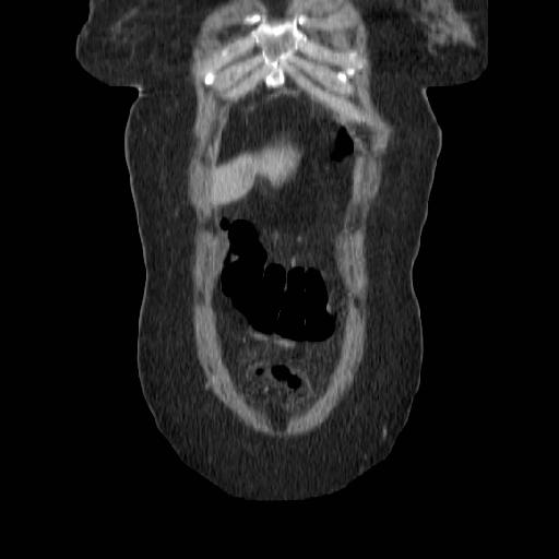 File:Acute perforated diverticulitis (Radiopaedia 14306-14191 Coronal C+ portal venous phase 3).jpg