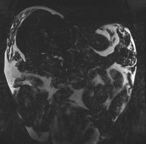 Acute portal vein thrombosis (Radiopaedia 73198-83925 Coronal Heavily T2 thin cuts 30).jpg