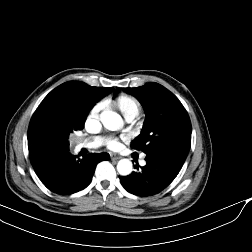 Acute pulmonary embolism (Radiopaedia 69510-79390 D 22).jpg