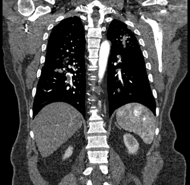 Acute pulmonary embolism with pulmonary infarcts (Radiopaedia 77688-89908 Coronal C+ CTPA 72).jpg