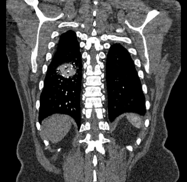 Acute pulmonary embolism with pulmonary infarcts (Radiopaedia 77688-89908 Coronal C+ CTPA 89).jpg