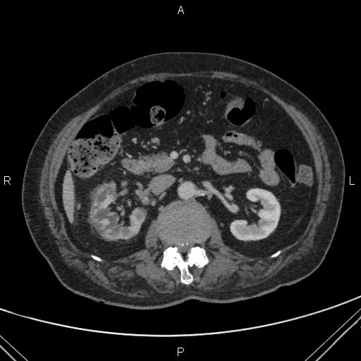 Acute renal artery occlusion (Radiopaedia 86586-102682 Axial C+ portal venous phase 32).jpg