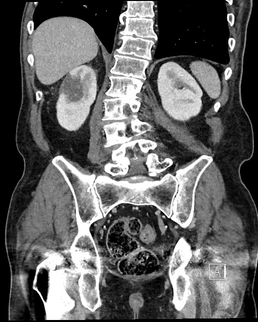 Acute renal infarction - rim capsular enhancement (Radiopaedia 59833-67270 Coronal C+ portal venous phase 46).jpg