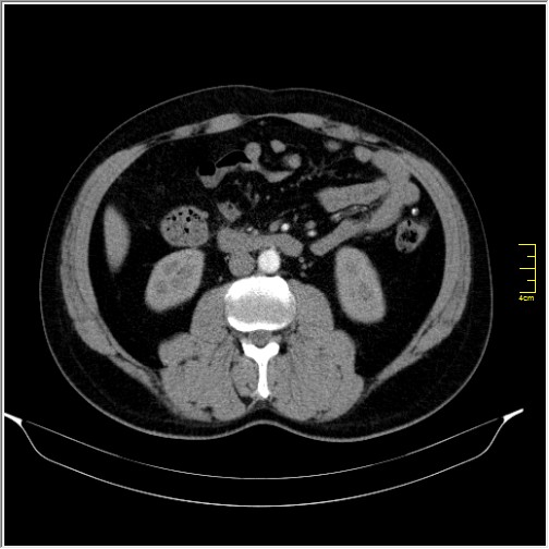 File:Acute right sided diverticulitis (Radiopaedia 65249-74268 Axial C+ portal venous phase 37).JPG