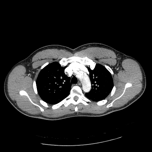 Acute segmental pulmonary emboli and pulmonary infarction (Radiopaedia 62264-70444 Axial C+ CTPA 36).jpg