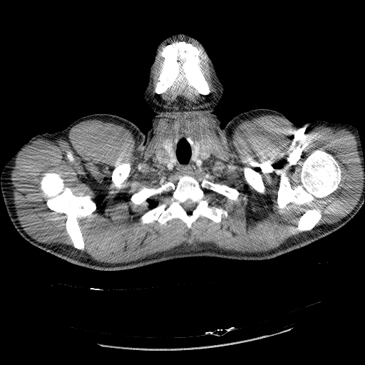 Acute segmental pulmonary emboli and pulmonary infarction (Radiopaedia 62264-70444 Axial C+ CTPA 8).jpg