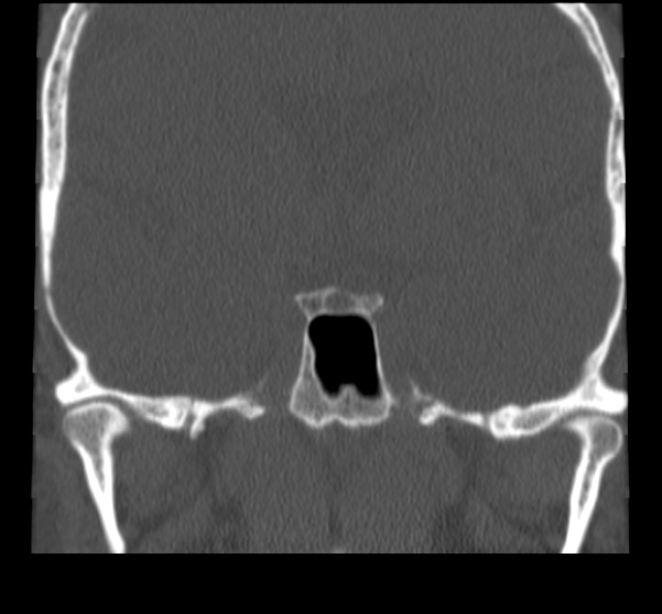 File:Acute sinusitis (Radiopaedia 23161-23215 Coronal bone window 56).jpg