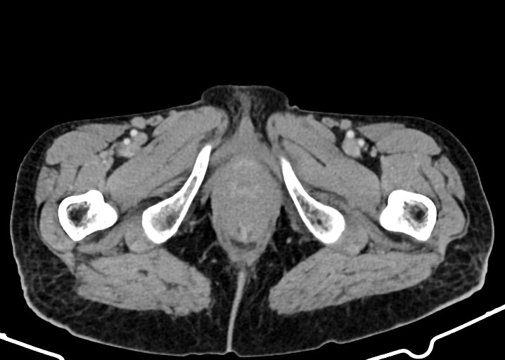 Acute small bowel (ileal) volvulus (Radiopaedia 71740-82139 Axial C+ portal venous phase 214).jpg