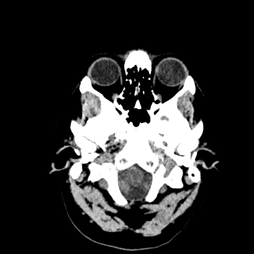 Acute subarachnoid hemorrhage and accessory anterior cerebral artery (Radiopaedia 69231-79008 Axial non-contrast 7).jpg