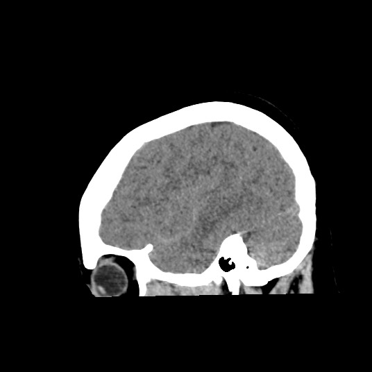 Acute subarachnoid hemorrhage and accessory anterior cerebral artery (Radiopaedia 69231-79008 Sagittal non-contrast 45).jpg