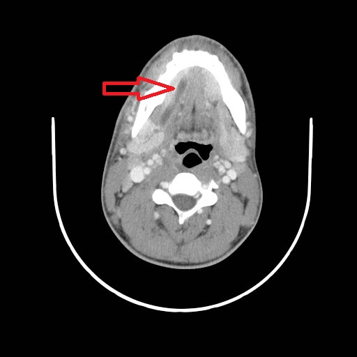 File:Acute submandibular sialadenitis secondary to ductal stone (Radiopaedia 27999-28267 Axial C+ delayed 3).jpg