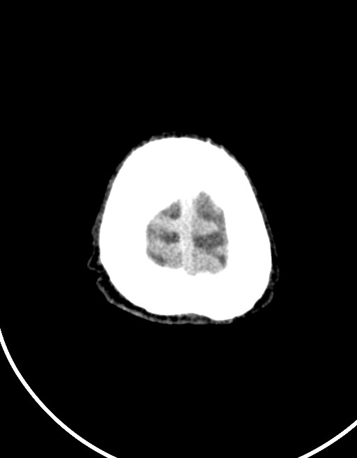 Acute superior cerebellar artery territory infarct (Radiopaedia 84104-99359 Axial non-contrast 10).jpg