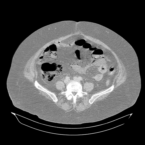 Acute superior mesenteric artery occlusion (Radiopaedia 51288-56960 Axial lung window 46).jpg