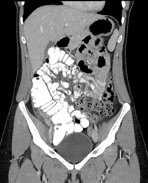 Acute uncomplicated appendicitis (Radiopaedia 61374-69304 Coronal C+ portal venous phase 37).jpg