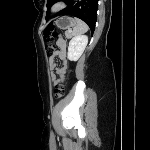 File:Acute uncomplicated appendicitis (Radiopaedia 73704-84499 Sagittal C+ portal venous phase 149).jpg
