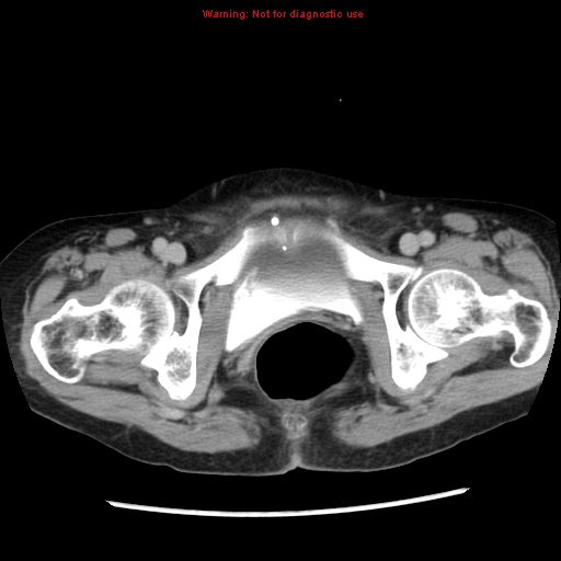 Adenocarcinoma of the colon (Radiopaedia 8191-9039 Axial renal excretory phase 59).jpg