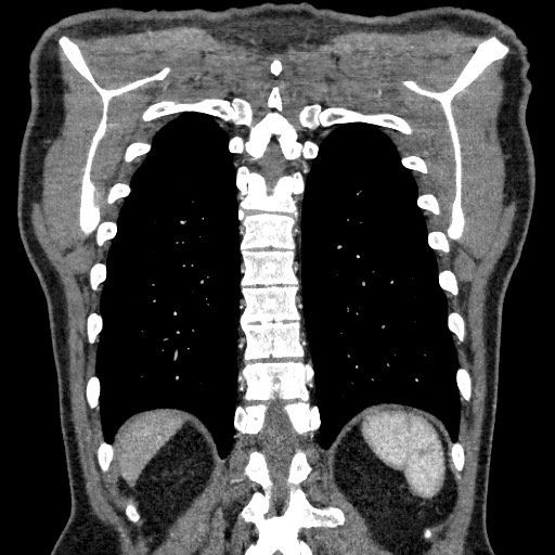 Adenocarcinoma of the lung (Radiopaedia 59871-67325 Coronal C+ arterial phase 59).jpg
