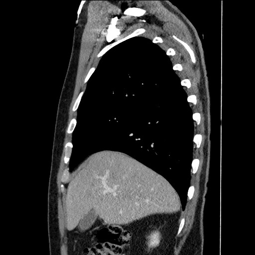 Adenocarcinoma of the lung (Radiopaedia 59871-67325 Sagittal C+ arterial phase 21).jpg