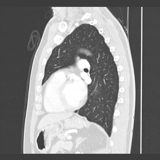 Adenocarcinoma of the lung (Radiopaedia 59871-67325 Sagittal lung window 64).jpg