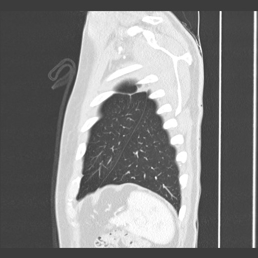 Adenocarcinoma of the lung (Radiopaedia 59871-67325 Sagittal lung window 90).jpg