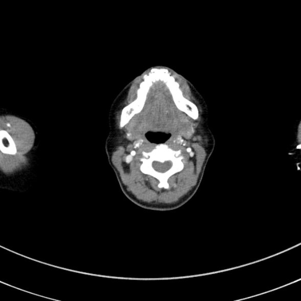 Adenocystic carcinoma of the trachea (Radiopaedia 47677-52525 Axial C+ arterial phase 13).jpg