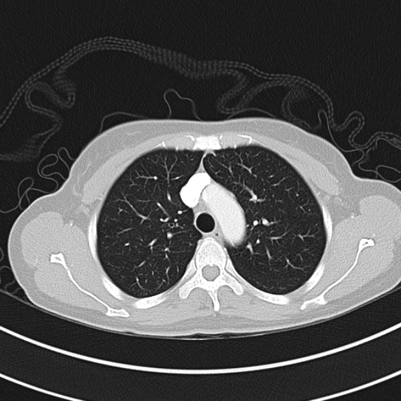File:Adenocystic carcinoma of the trachea (Radiopaedia 47677-52525 Axial lung window 41).jpg