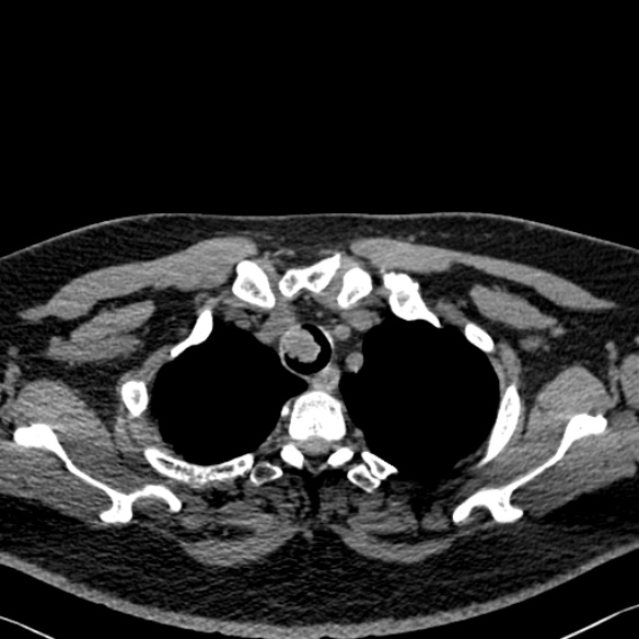 Adenoid cystic carcinoma of the trachea (Radiopaedia 49042-54137 Axial non-contrast 50).jpg