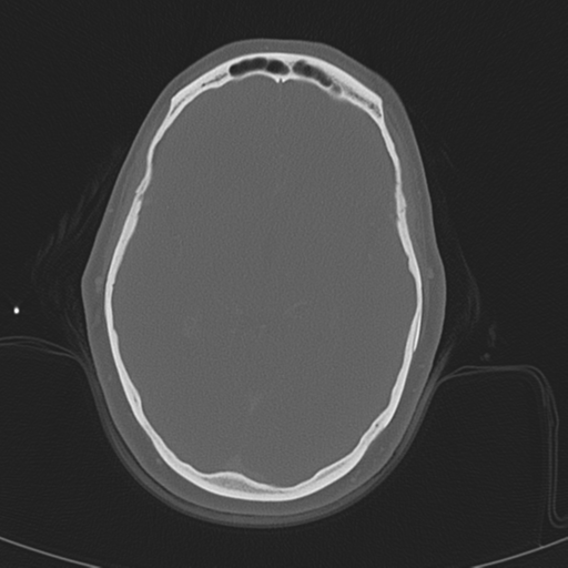 Adenoid cystic tumor of palate (Radiopaedia 46980-51518 Axial bone window 4).png
