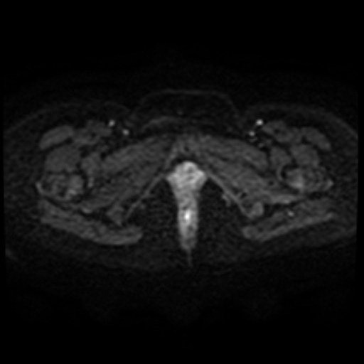 File:Adenoma malignum of cervix (Radiopaedia 66441-75705 Axial DWI 49).jpg