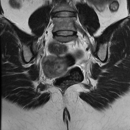 File:Adenoma malignum of cervix (Radiopaedia 66441-75705 Coronal T2 18).jpg
