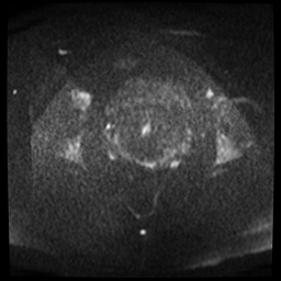 File:Adenomyosis-scar endometriosis (Radiopaedia 65863-75022 Axial DWI 12).jpg
