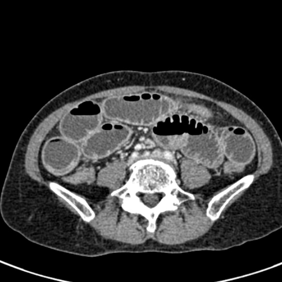 Adhesional small bowel obstruction (Radiopaedia 48397-53305 Axial C+ portal venous phase 57).jpg