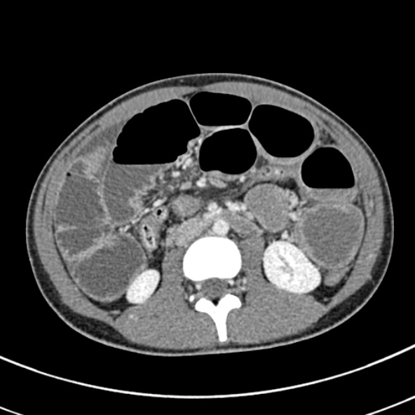 File:Adhesional small bowel obstruction (Radiopaedia 52107-57980 Axial C+ portal venous phase 55).jpg