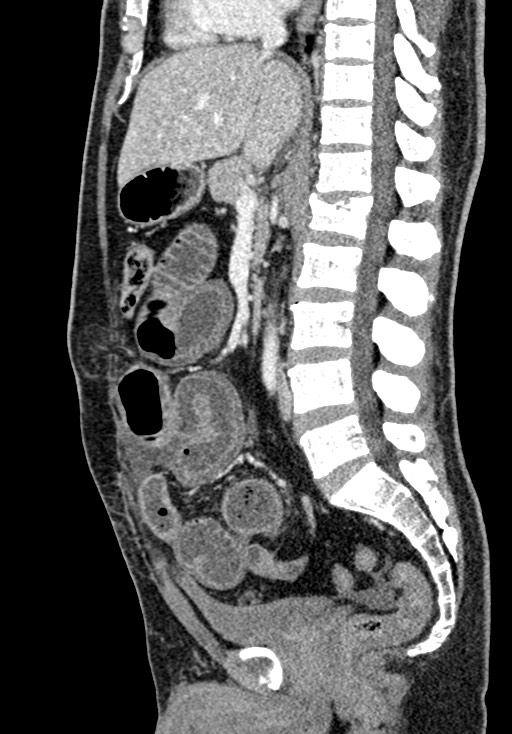 Adhesional small bowel obstruction (Radiopaedia 58900-66131 Sagittal C+ portal venous phase 124).jpg
