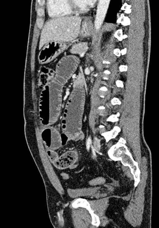 Adhesional small bowel obstruction (Radiopaedia 58900-66131 Sagittal C+ portal venous phase 146).jpg