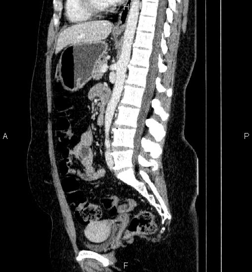 File:Adrenal cortical carcinoma (Radiopaedia 84882-100379 Sagittal C+ portal venous phase 49).jpg