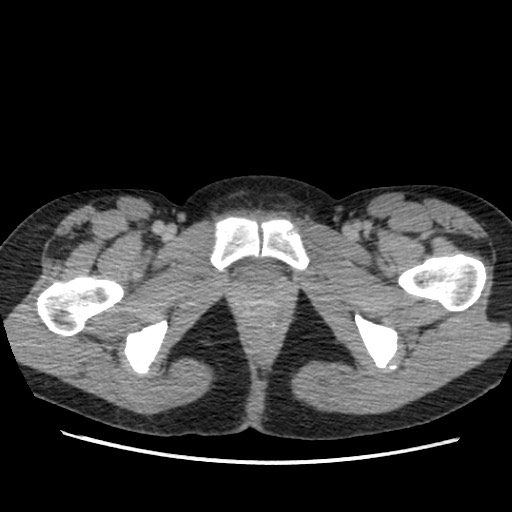File:Adrenal cyst (Radiopaedia 64869-73813 Axial C+ portal venous phase 82).jpg