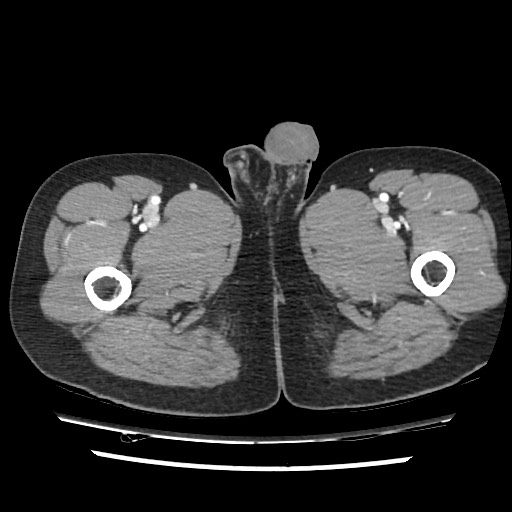 File:Adrenal gland trauma (Radiopaedia 81351-95078 Axial Dual bolus trauma C+ 134).jpg