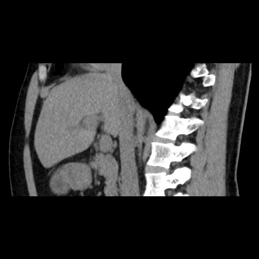 Adrenal gland trauma (Radiopaedia 81351-95079 Sagittal non-contrast 44).jpg