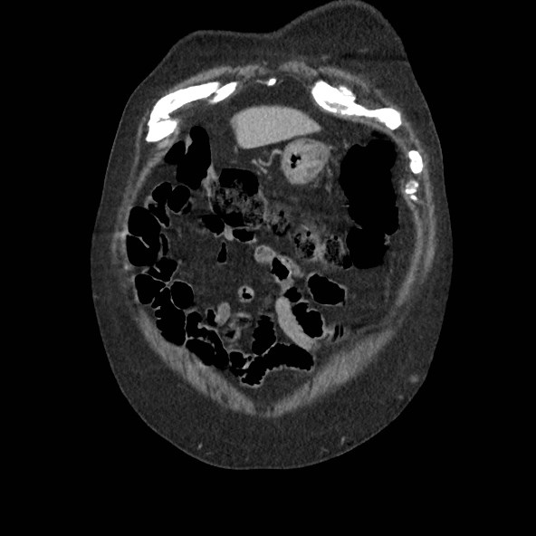 Adrenal lymphoma (Radiopaedia 84145-99415 Coronal C+ portal venous phase 6).jpg
