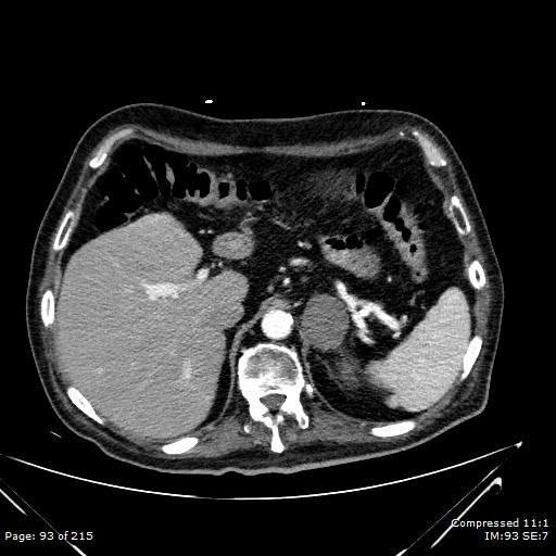 File:Adrenal metastasis (Radiopaedia 78425-91079 Axial C+ arterial phase 23).jpg