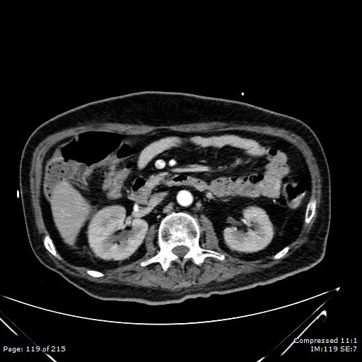 Adrenal metastasis (Radiopaedia 78425-91079 Axial C+ arterial phase 49).jpg