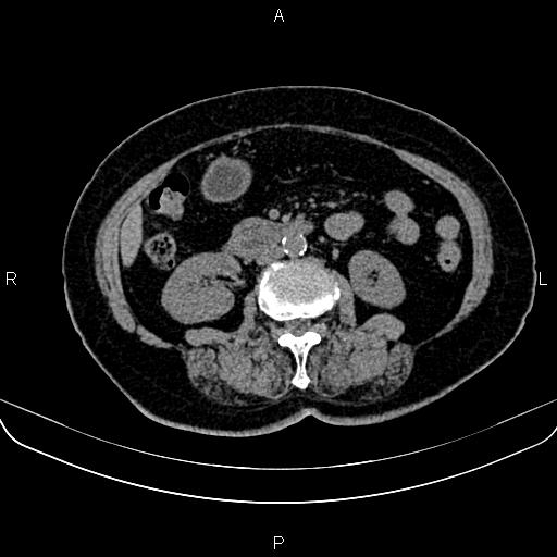 Adrenal myelolipoma (Radiopaedia 82742-96986 Axial non-contrast 78).jpg
