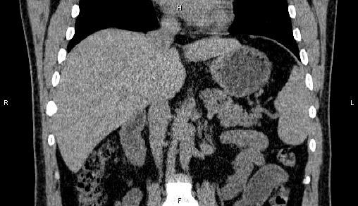 File:Adrenal myelolipoma (Radiopaedia 84321-99619 Coronal non-contrast 42).jpg