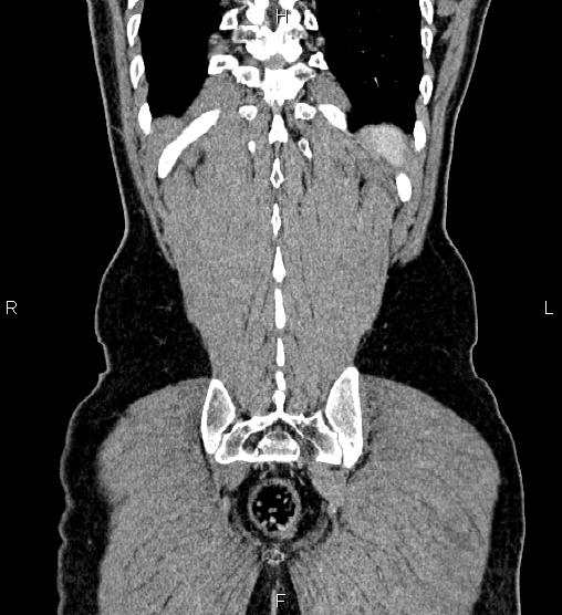 Adrenal myelolipoma (Radiopaedia 87794-104246 Coronal renal cortical phase 59).jpg