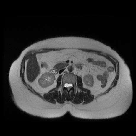 File:Adrenal myelolipoma - MRI (Radiopaedia 83249-97646 Axial T2 23).jpg