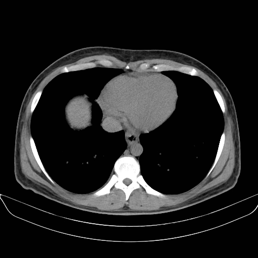 Adrenal myelolipoma - bilateral (Radiopaedia 74805-85810 Axial non-contrast 1).jpg